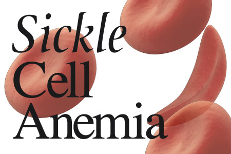 Sickle Cell Anemia Sickle Cell Anemia