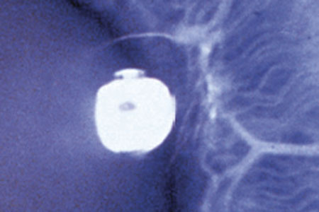Cataracts: What The Eye can see Cataracts: What The Eye can see